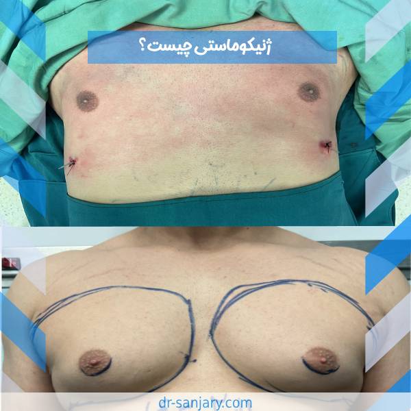 ژنیکوماستی