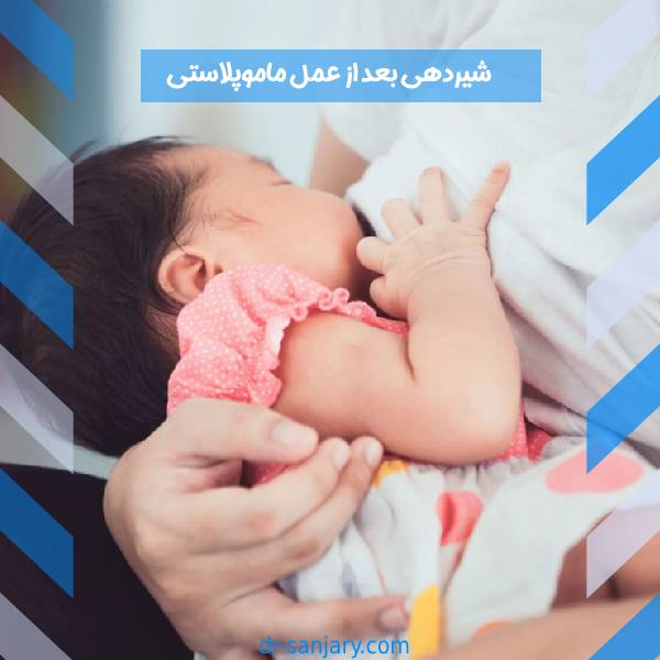 شیردهی بعد از ماموپلاستی