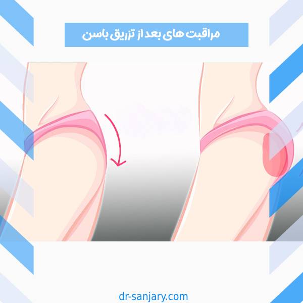 مراقبتهای بعد از تزریق باسن