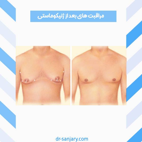 مراقبت های بعد از ژنیکوماستی