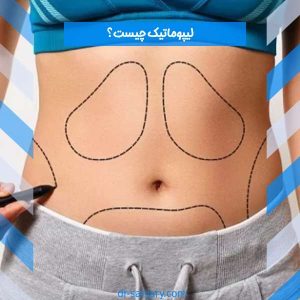 لیپوماتیک در تهران _ دکتر خشایار سنجری