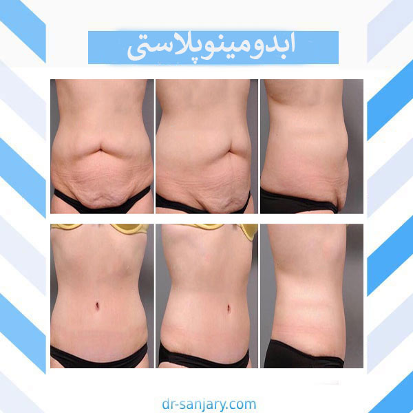 نمونه کار جراحی ابدومینوپلاستی _ دکتر خشایار سنجری