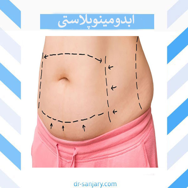 عمل تامی تاک یا جراحی ابدومینوپلاستی _ دکتر خشایار سنجری