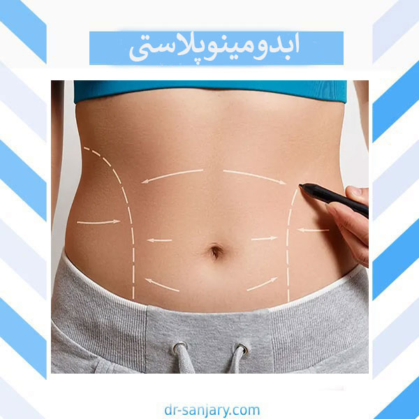 ابدومینوپلاستی در تهران _ دکتر خشایار سنجری