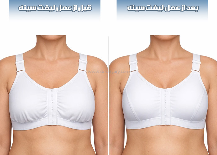 عکس قبل و بعد از لیفت سینه