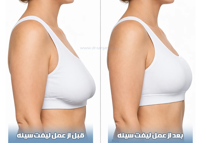 عکس قبل و بعد از لیفت سینه