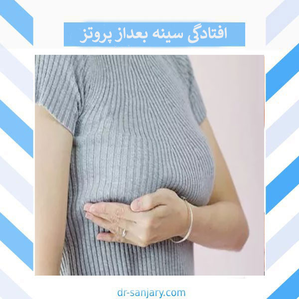 افتادگی سینه بعد از عمل _ دکتر خشایار سنجری