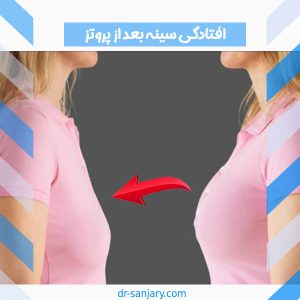 افتادگی سینه بعد از پروتز