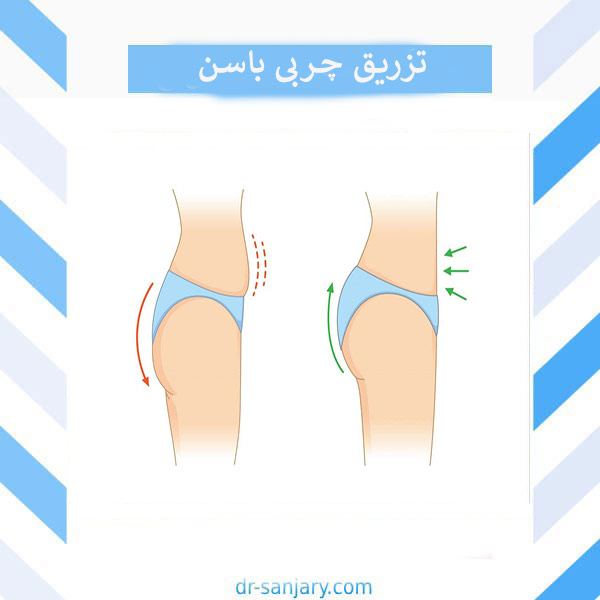 تزریق چربی باسن _ دکتر خشایار سنجری