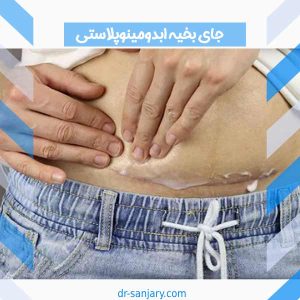 جای بخیه ابدومینوپلاستی _ دکتر خشایار سنجری