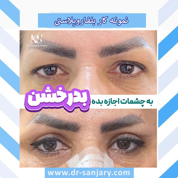 عمل زیبایی پلک در تهران _ دکتر خشایار سنجری