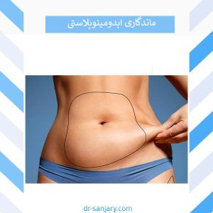 ماندگاری ابدومینوپلاستی _ دکتر خشایار سنجری