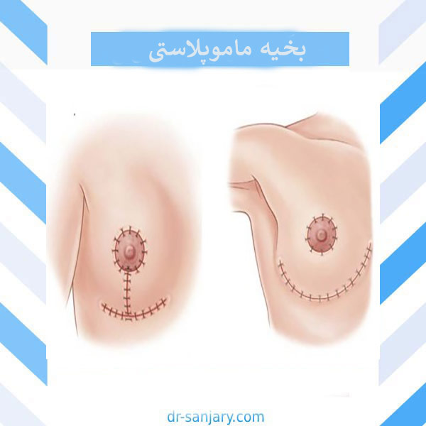 بخیه ماموپلاستی _ دکتر خشایار سنجری