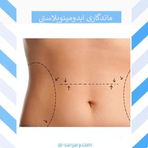 روش های افزایش ماندگاری ابدومینوپلاستی _ دکتر خشایار سنجری