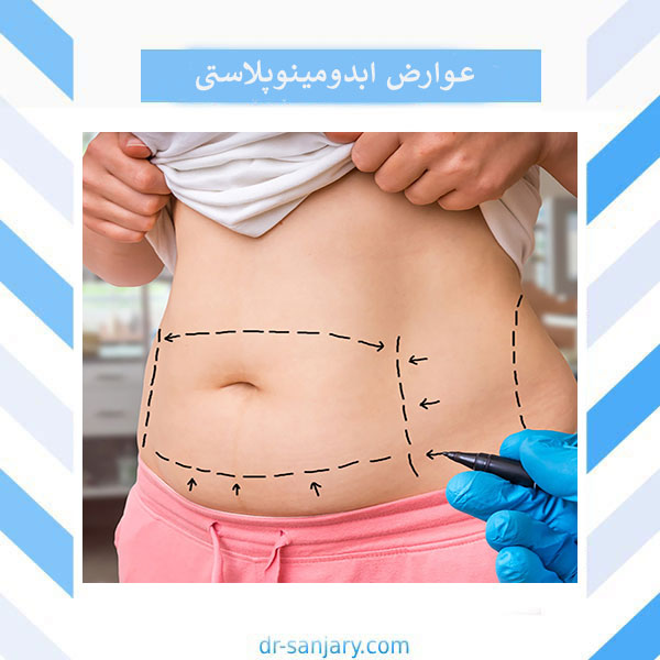 عوارض جراحی ابدومینوپلاستی _ دکتر خشایار سنجری