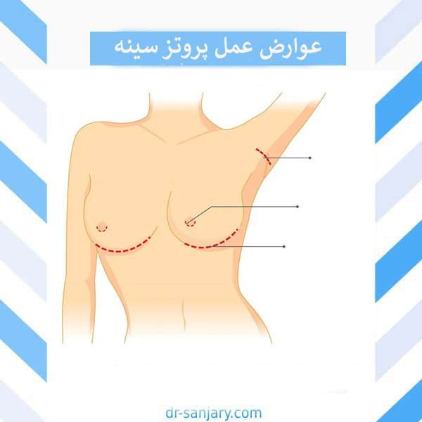 عوارض عمل پروتز سینه _ دکتر خشایار سنجری