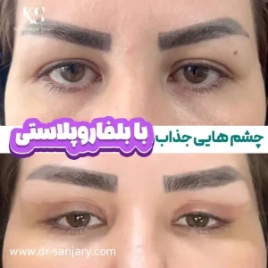 بهترین جراح پلک در تهران _ دکتر خشایار سنجری