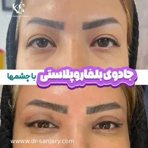 بهترین جراح بلفاروپلاستی در تهران _ دکتر خشایار سنجری