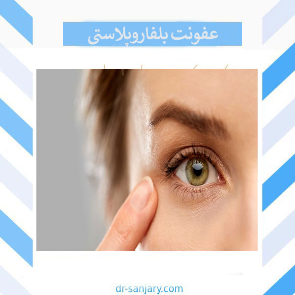 عفونت بلفاروپلاستی _ دکتر خشایار سنجری
