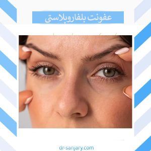 عفونت بلفاروپلاستی _ دکتر خشایار سنجری