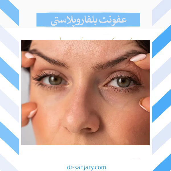 عفونت بلفاروپلاستی _ دکتر خشایار سنجری