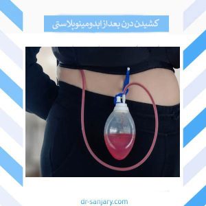 کشیدن درن بعد از ابدومینوپلاستی _ دکتر خشایار سنجری