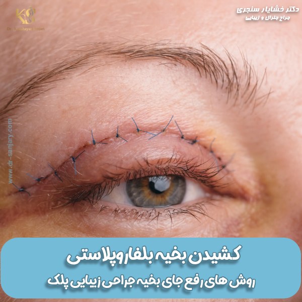 عکس بخیه بلفاروپلاستی