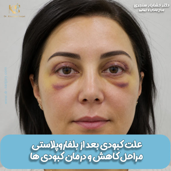 عکس کیودسی بعد از بلفاروپلاستی