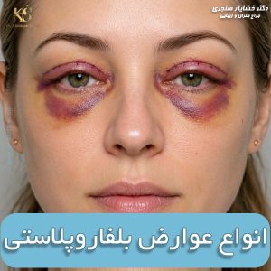 انواع عوارض بلفاروپلاستی + عوارض شایع بعد از جراحی پلک