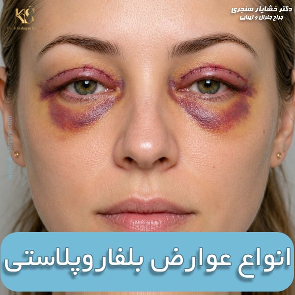 انواع عوارض بلفاروپلاستی + عوارض شایع بعد از جراحی پلک