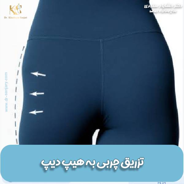 تزریق چربی به هیپ دیپ
