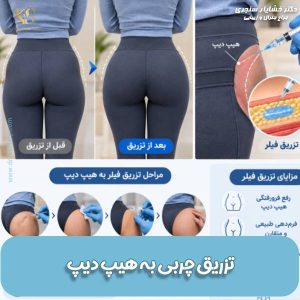 تزریق چربی به هیپ دیپ